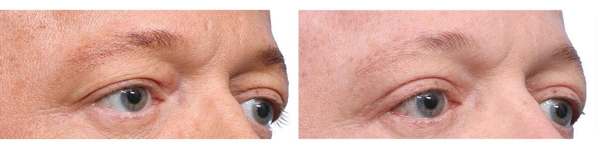 Blepharoplasty (Eyelid Surgery) Before & After Gallery - Patient 121103 - Image 2