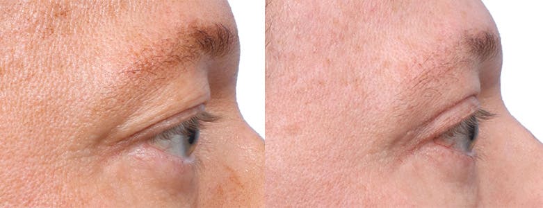 Blepharoplasty (Eyelid Surgery) Before & After Gallery - Patient 121103 - Image 3