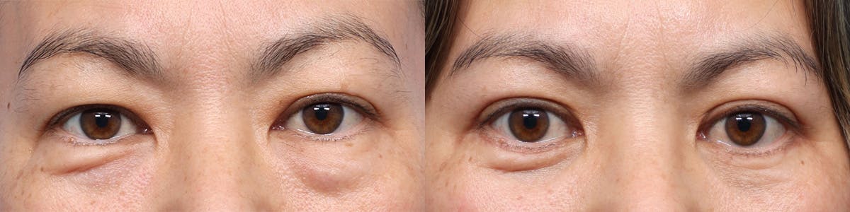 Blepharoplasty (Eyelid Surgery) Before & After Gallery - Patient 370494 - Image 1