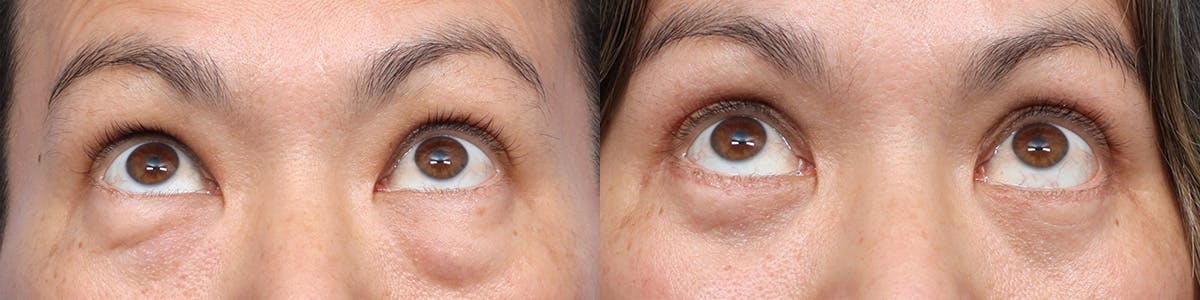 Blepharoplasty (Eyelid Surgery) Before & After Gallery - Patient 370494 - Image 2