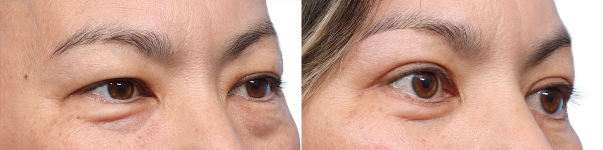 Blepharoplasty (Eyelid Surgery) Before & After Gallery - Patient 370494 - Image 3