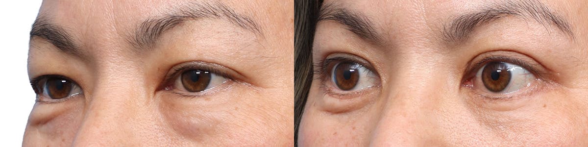Blepharoplasty (Eyelid Surgery) Before & After Gallery - Patient 370494 - Image 4