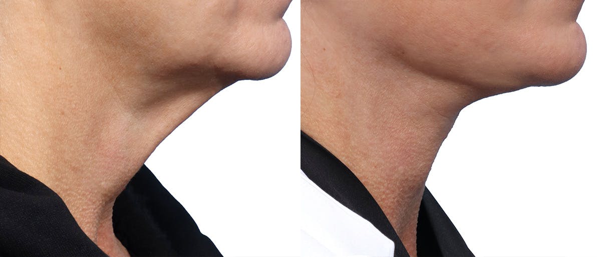 Deep Plane Facelift Before & After Gallery - Patient 146439 - Image 2