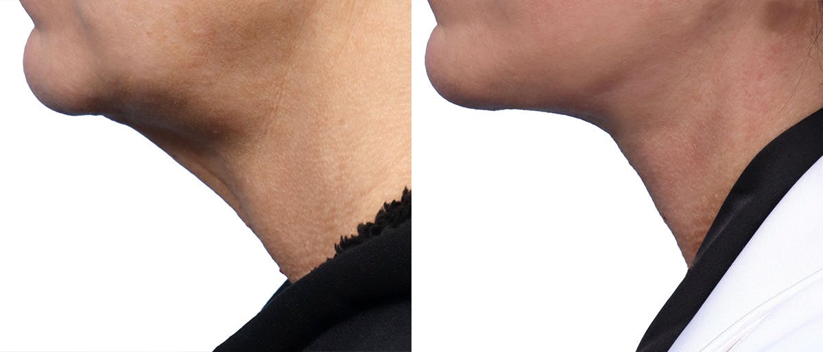 Deep Plane Facelift Before & After Gallery - Patient 146439 - Image 3