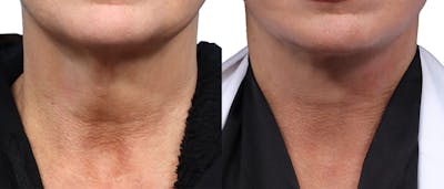 Deep Plane Facelift Before & After Gallery - Patient 146439 - Image 1