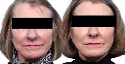 Lutronic Ultra Before & After Gallery - Patient 619059 - Image 1