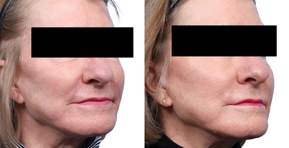 Lutronic Ultra Before & After Gallery - Patient 619059 - Image 2
