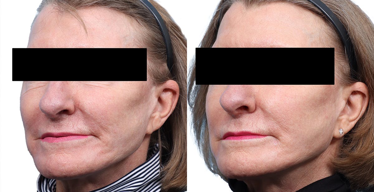 Lutronic Ultra Before & After Gallery - Patient 619059 - Image 3
