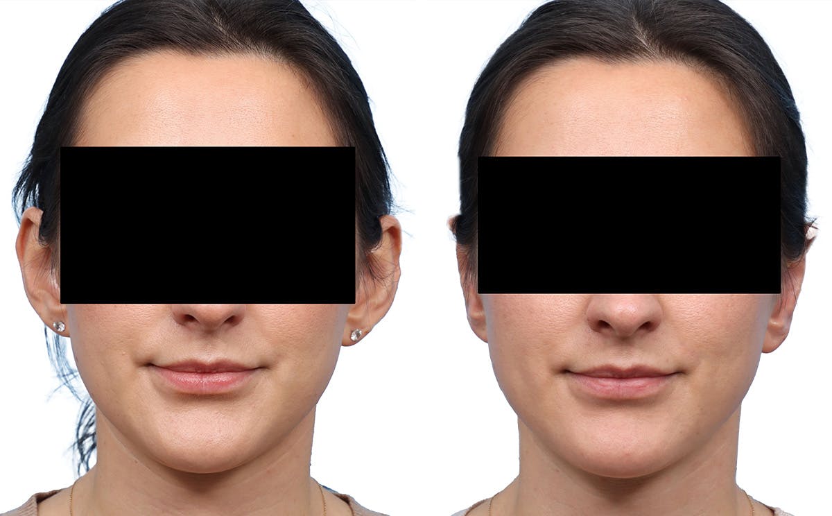 Otoplasty (Ear Surgery) Before & After Gallery - Patient 158762 - Image 1