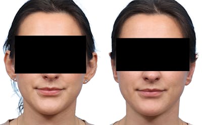 Otoplasty (Ear Surgery) Before & After Gallery - Patient 158762 - Image 1