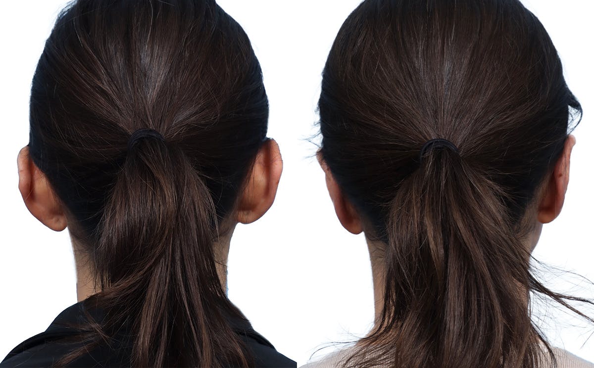 Otoplasty (Ear Surgery) Before & After Gallery - Patient 158762 - Image 2