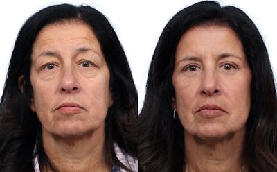 Blepharoplasty (Eyelid Surgery) Before & After Gallery - Patient 134925 - Image 1