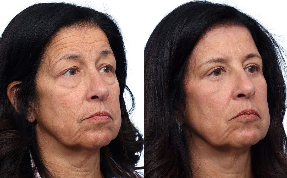 Blepharoplasty (Eyelid Surgery) Before & After Gallery - Patient 134925 - Image 2