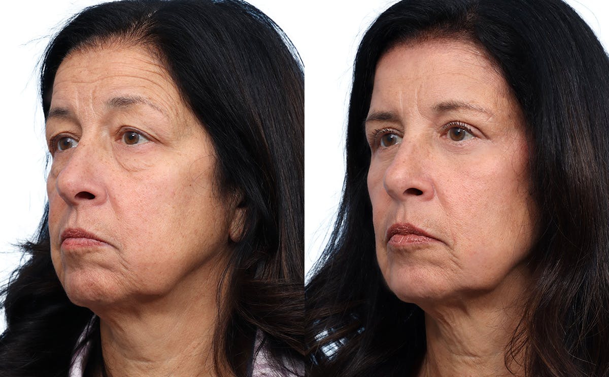 Blepharoplasty (Eyelid Surgery) Before & After Gallery - Patient 134925 - Image 3