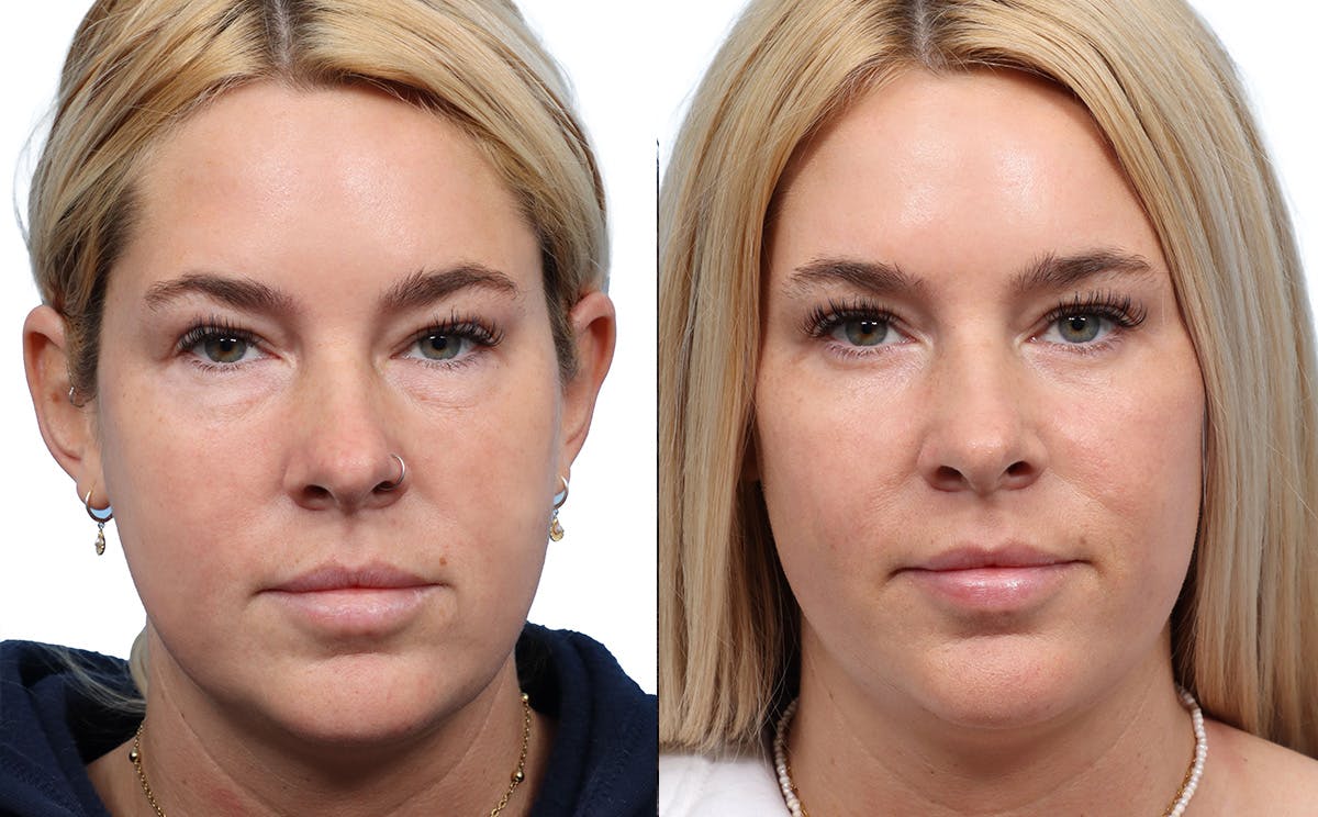 Blepharoplasty (Eyelid Surgery) Before & After Gallery - Patient 177723 - Image 1