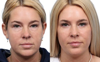 Blepharoplasty (Eyelid Surgery) Before & After Gallery - Patient 177723 - Image 1