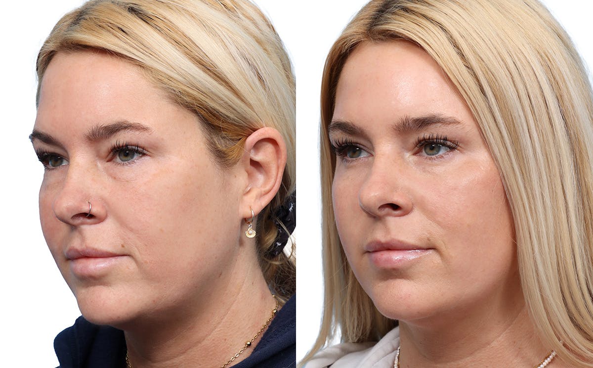 Blepharoplasty (Eyelid Surgery) Before & After Gallery - Patient 177723 - Image 2
