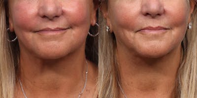 Ultherapy® Before & After Gallery - Patient 355705 - Image 1
