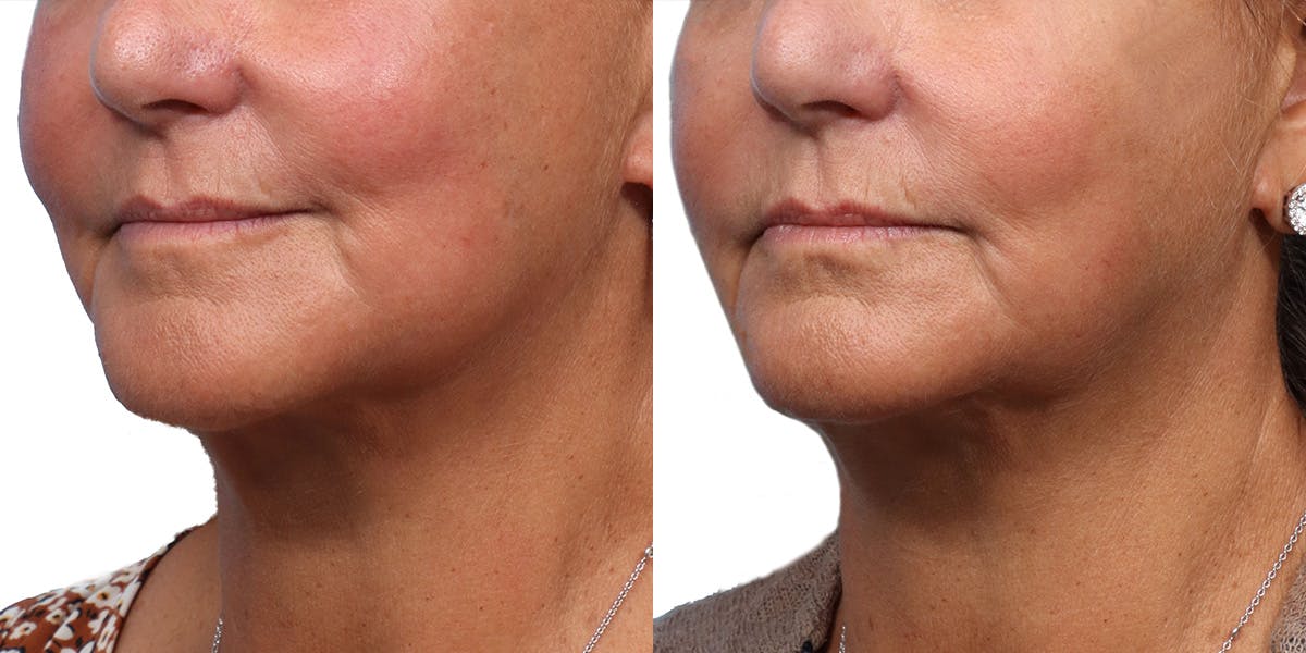 Ultherapy® Before & After Gallery - Patient 355705 - Image 2
