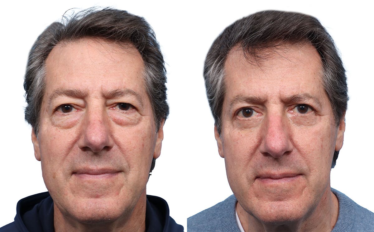 Blepharoplasty (Eyelid Surgery) Before & After Gallery - Patient 256586 - Image 1