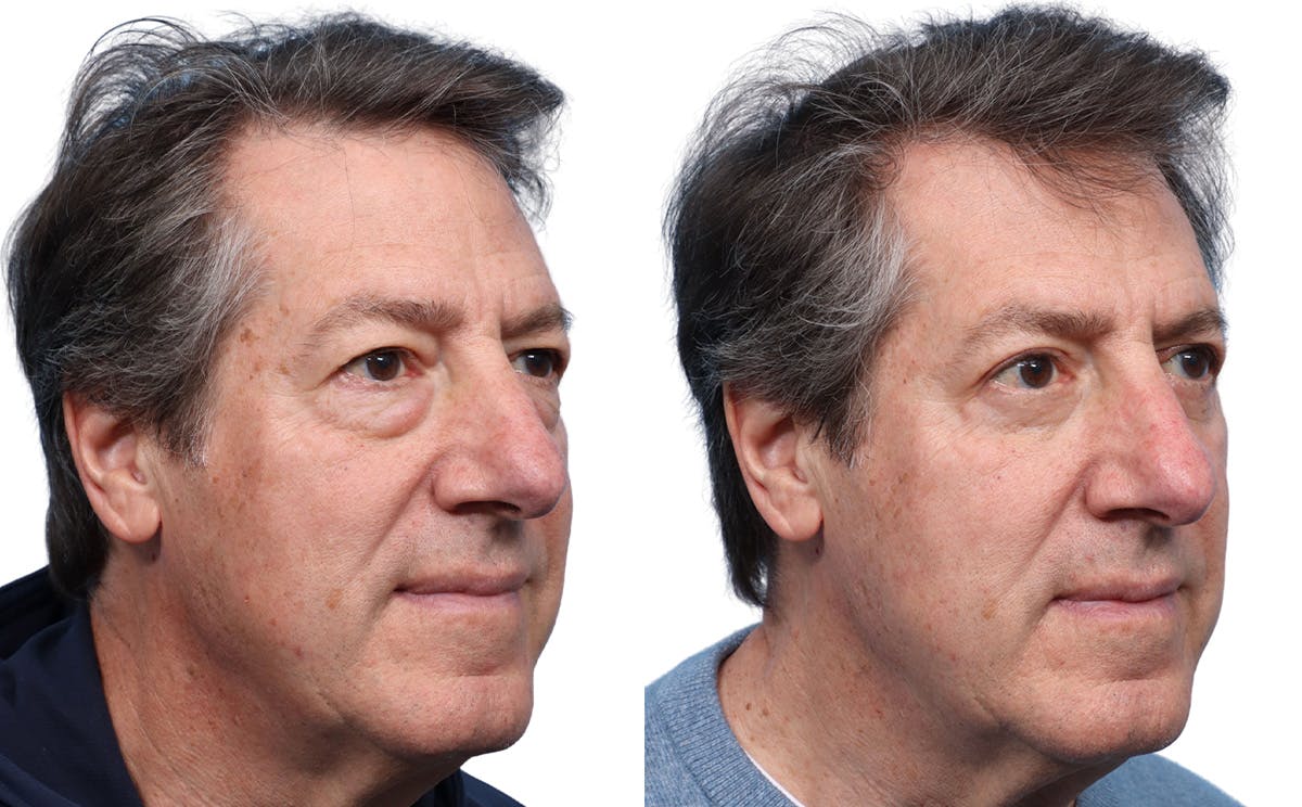 Blepharoplasty (Eyelid Surgery) Before & After Gallery - Patient 256586 - Image 2