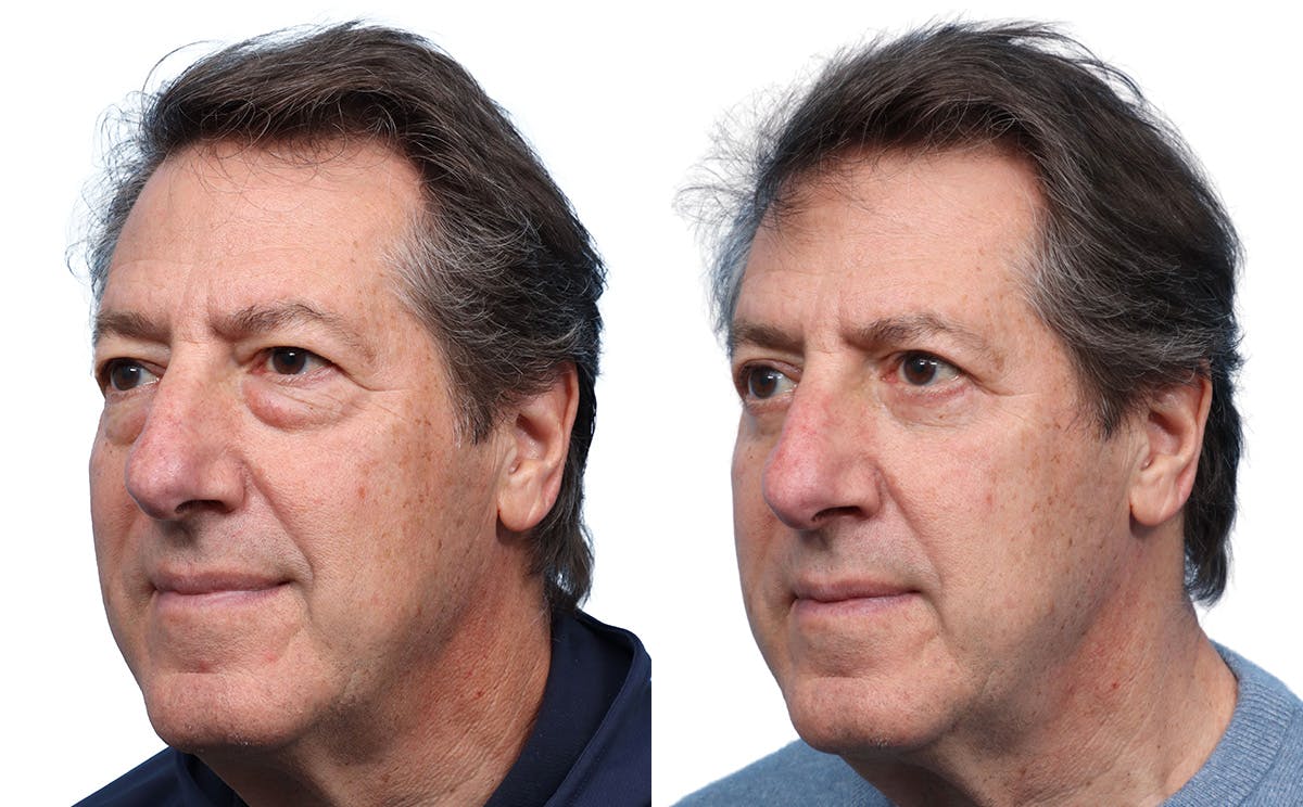 Blepharoplasty (Eyelid Surgery) Before & After Gallery - Patient 256586 - Image 3