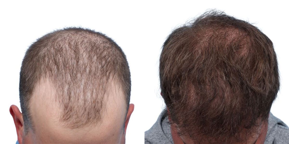 FUE Hair Transplant Before & After Gallery - Patient 159374 - Image 2