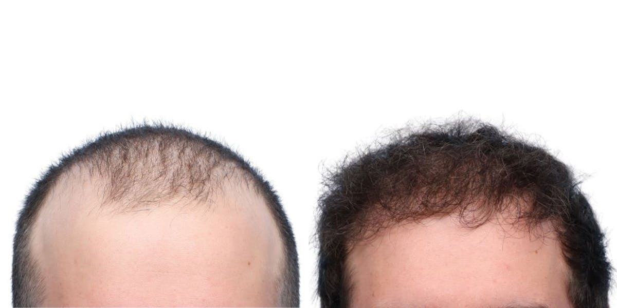 FUE Hair Transplant Before & After Gallery - Patient 159374 - Image 1