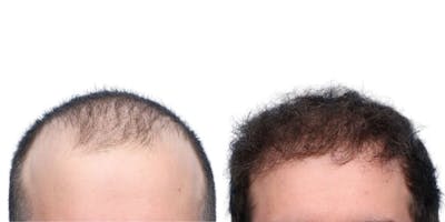 FUE Hair Transplant Before & After Gallery - Patient 159374 - Image 1
