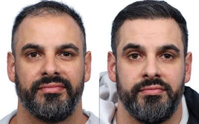 FUE Hair Transplant Before & After Gallery - Patient 190441 - Image 1