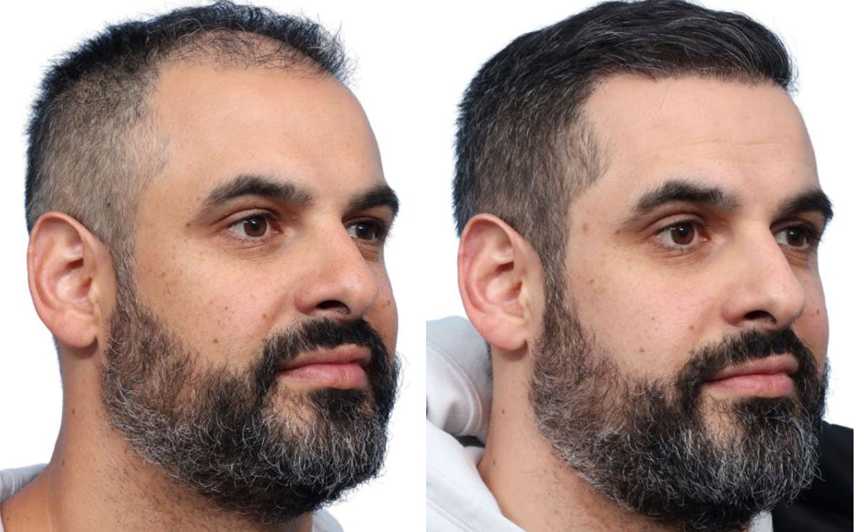 FUE Hair Transplant Before & After Gallery - Patient 190441 - Image 3