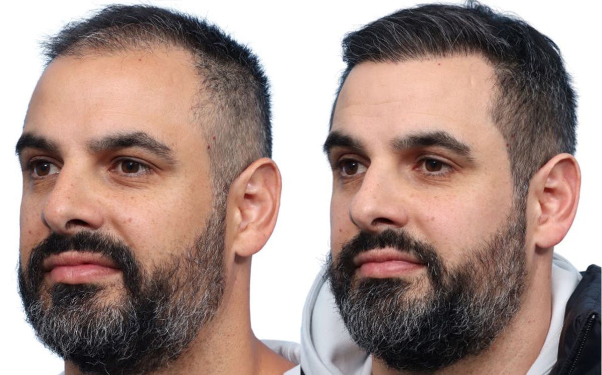 FUE Hair Transplant Before & After Gallery - Patient 190441 - Image 4
