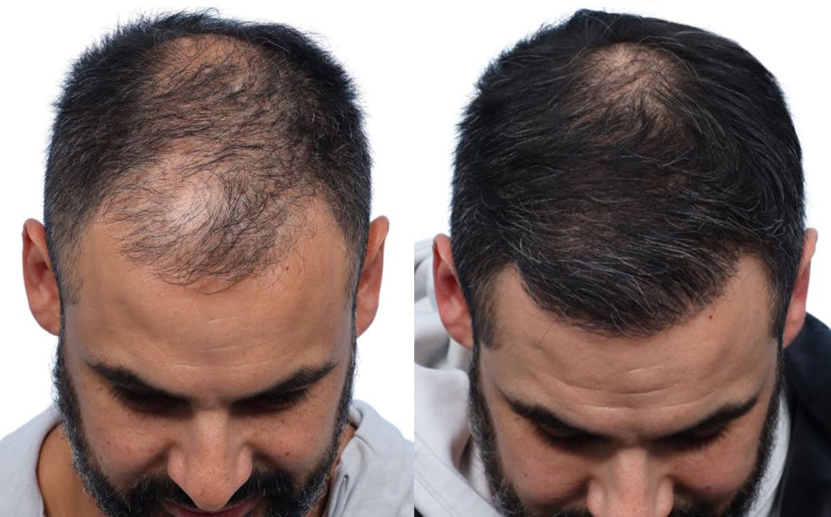 FUE Hair Transplant Before & After Gallery - Patient 190441 - Image 2