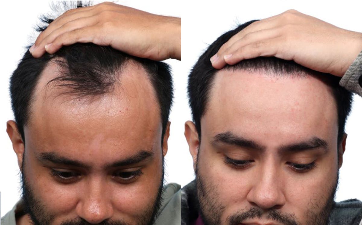 FUE Hair Transplant Before & After Gallery - Patient 260379 - Image 1