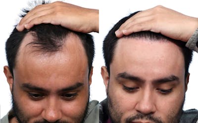 FUE Hair Transplant Before & After Gallery - Patient 260379 - Image 1