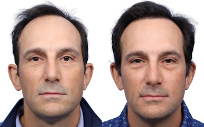 FUE Hair Transplant Before & After Gallery - Patient 282344 - Image 1