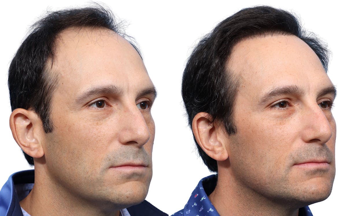 FUE Hair Transplant Before & After Gallery - Patient 282344 - Image 3
