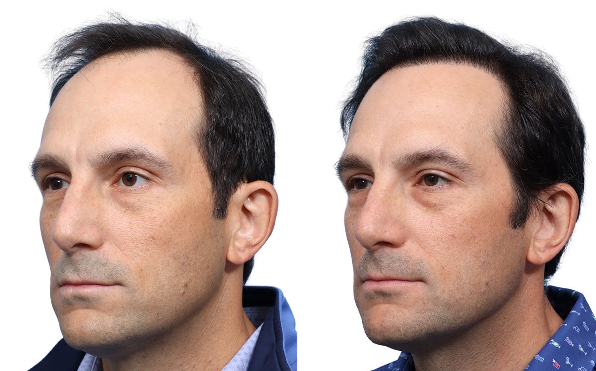 FUE Hair Transplant Before & After Gallery - Patient 282344 - Image 4