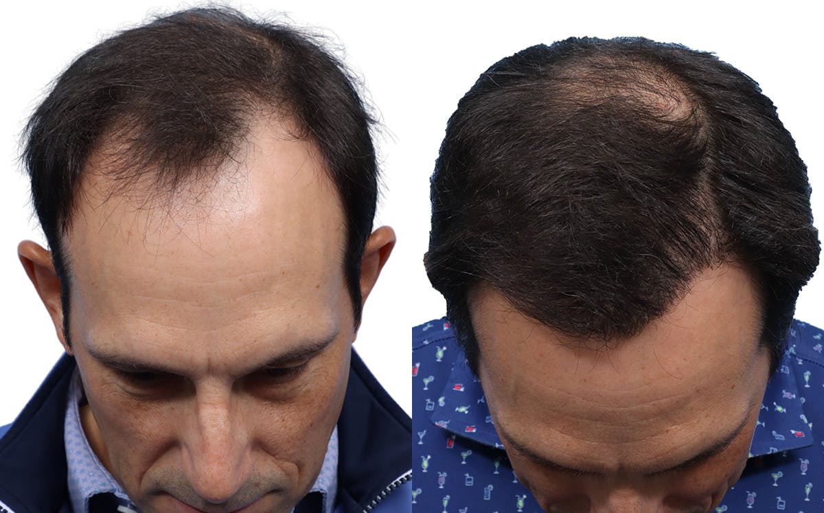 FUE Hair Transplant Before & After Gallery - Patient 282344 - Image 2