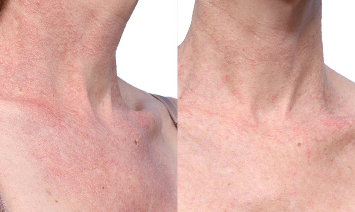 VBeam® Before & After Gallery - Patient 367635 - Image 2