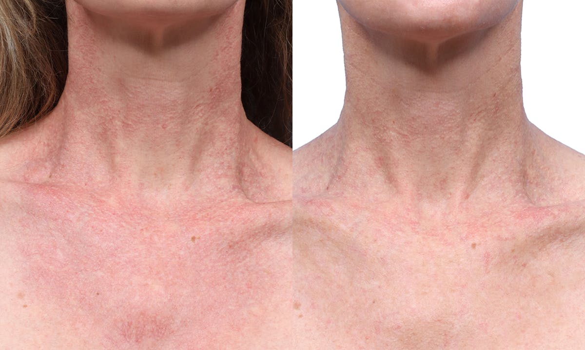 VBeam® Before & After Gallery - Patient 367635 - Image 1