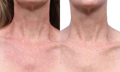 VBeam® Before & After Gallery - Patient 367635 - Image 1