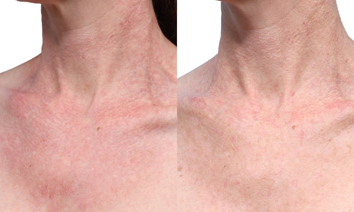 VBeam® Before & After Gallery - Patient 367635 - Image 3