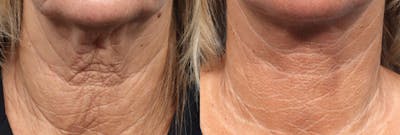 CO2 Laser Before & After Gallery - Patient 231200 - Image 1