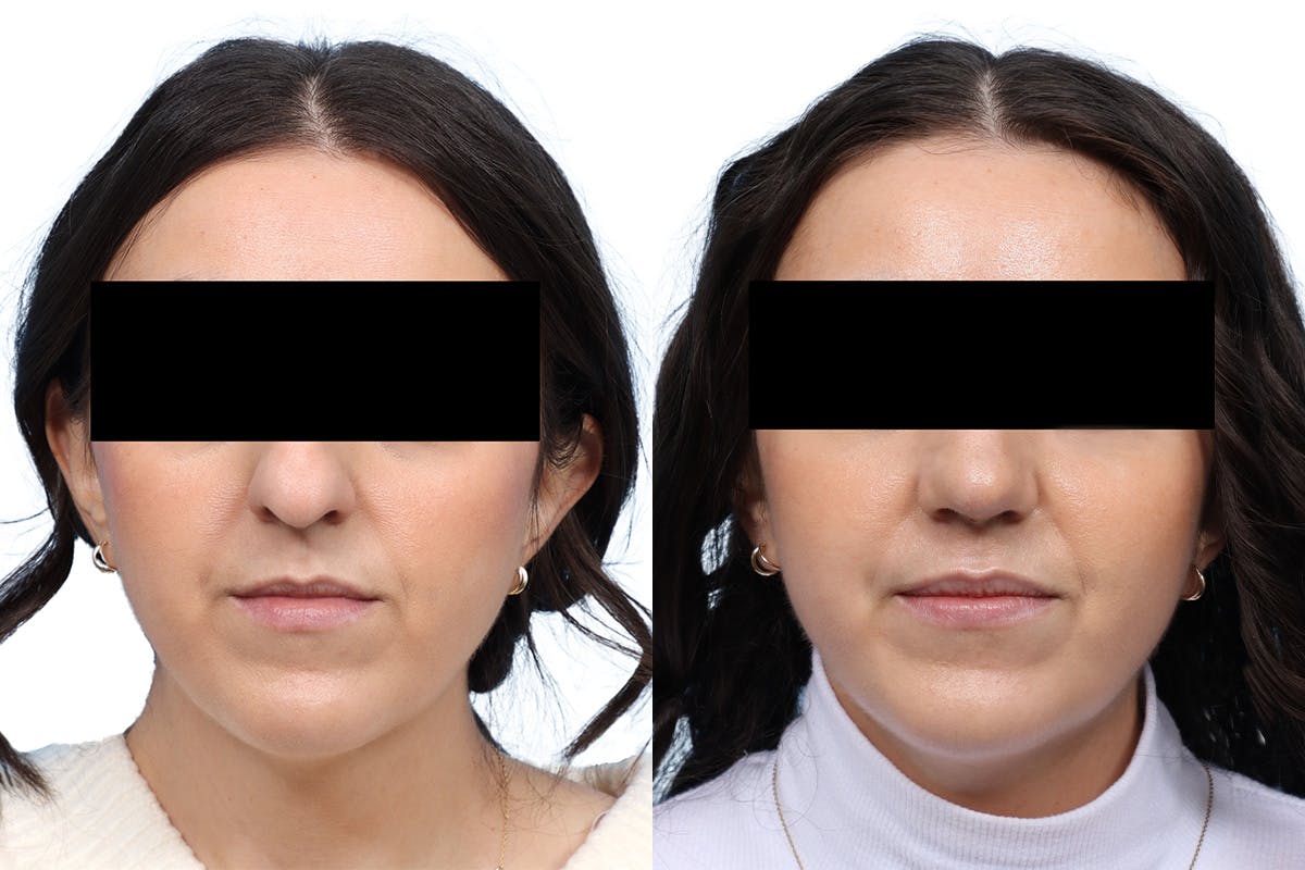 Rhinoplasty Before & After Gallery - Patient 802024 - Image 3