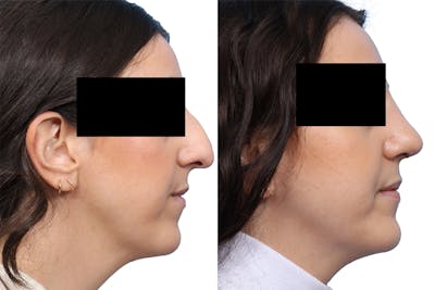 Rhinoplasty Before & After Gallery - Patient 802024 - Image 1