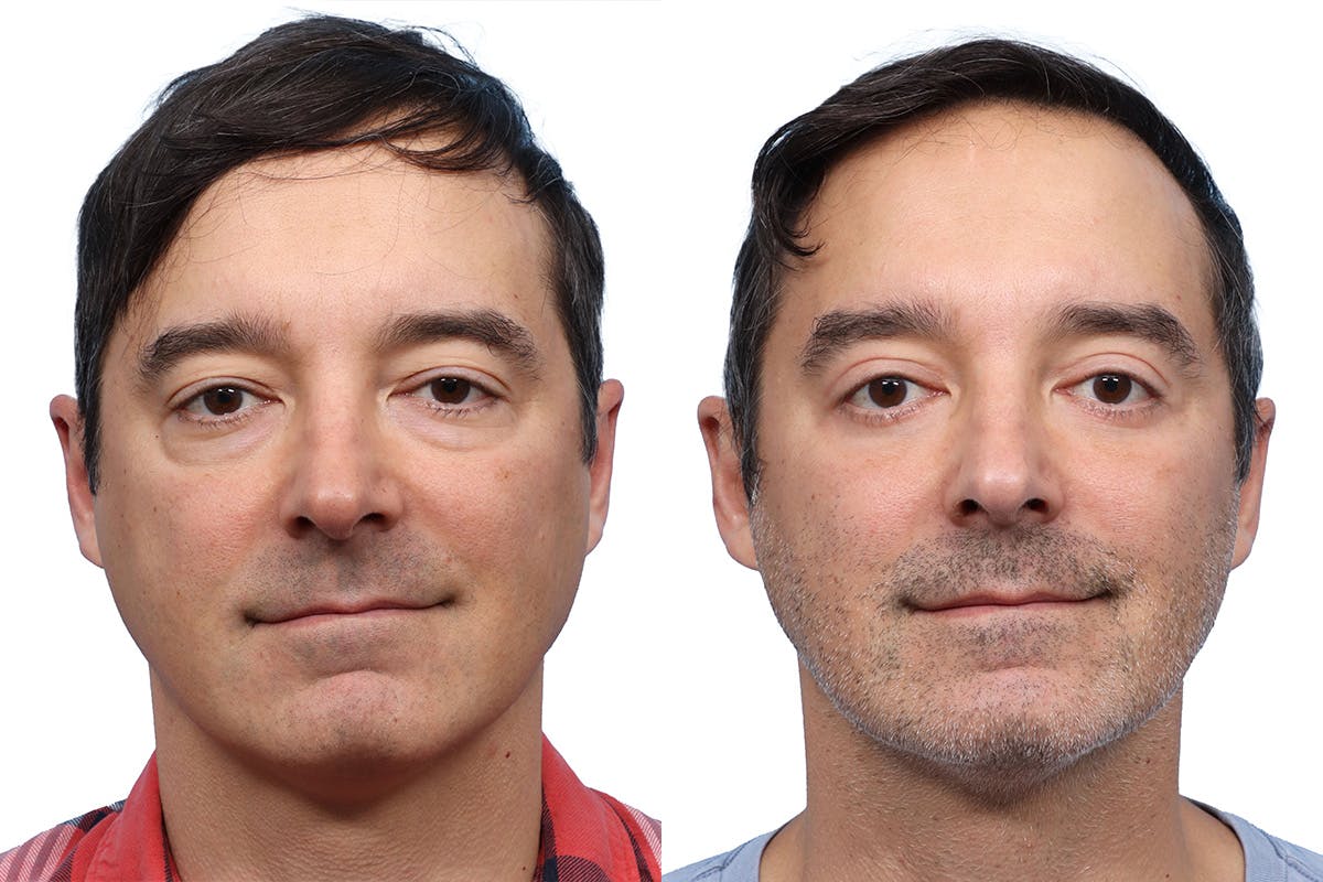 Blepharoplasty (Eyelid Surgery) Before & After Gallery - Patient 127209 - Image 1