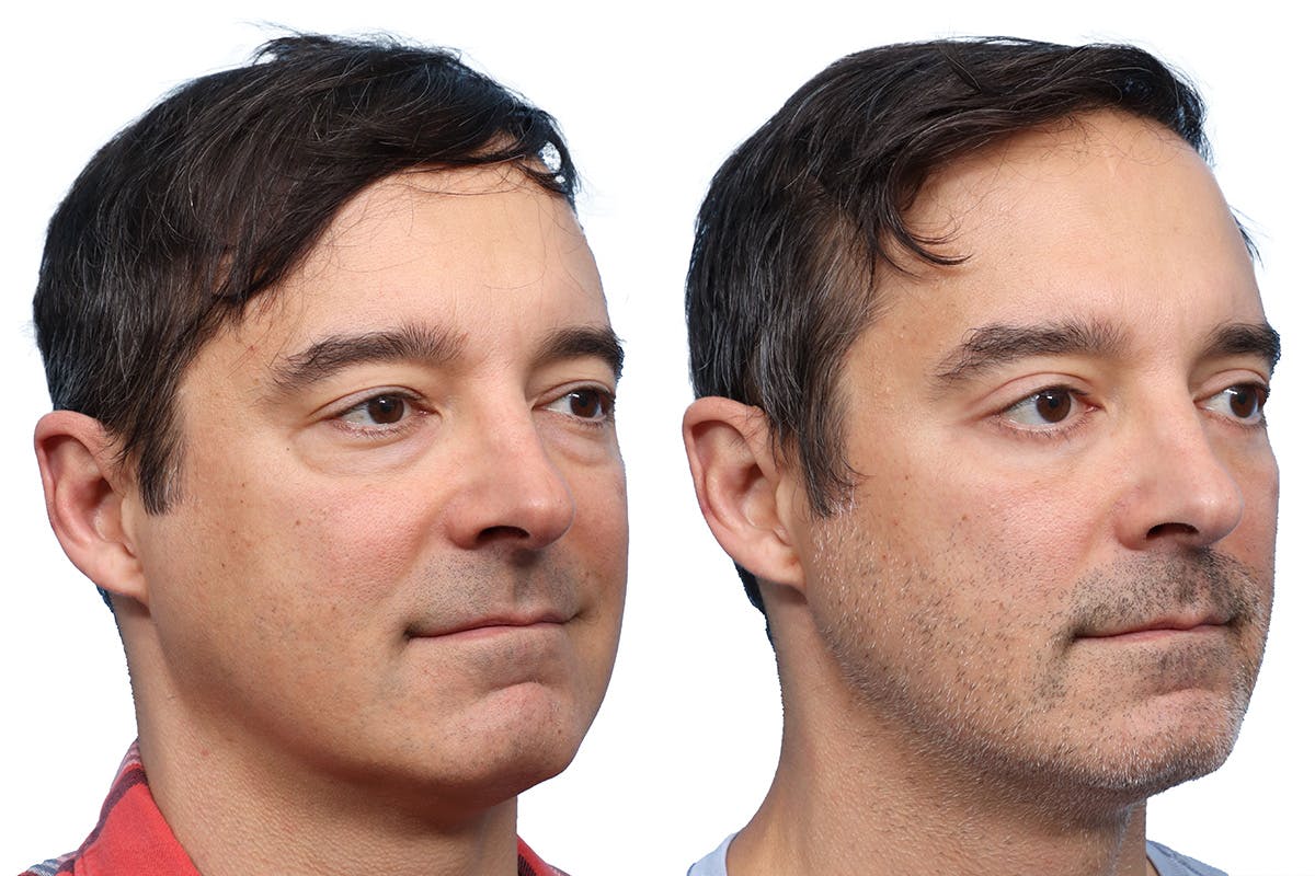 Blepharoplasty (Eyelid Surgery) Before & After Gallery - Patient 127209 - Image 2
