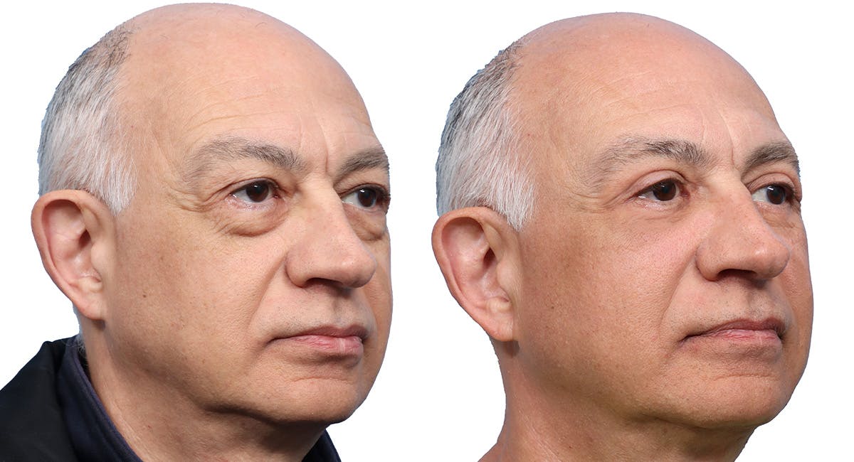 Blepharoplasty (Eyelid Surgery) Before & After Gallery - Patient 163451 - Image 3