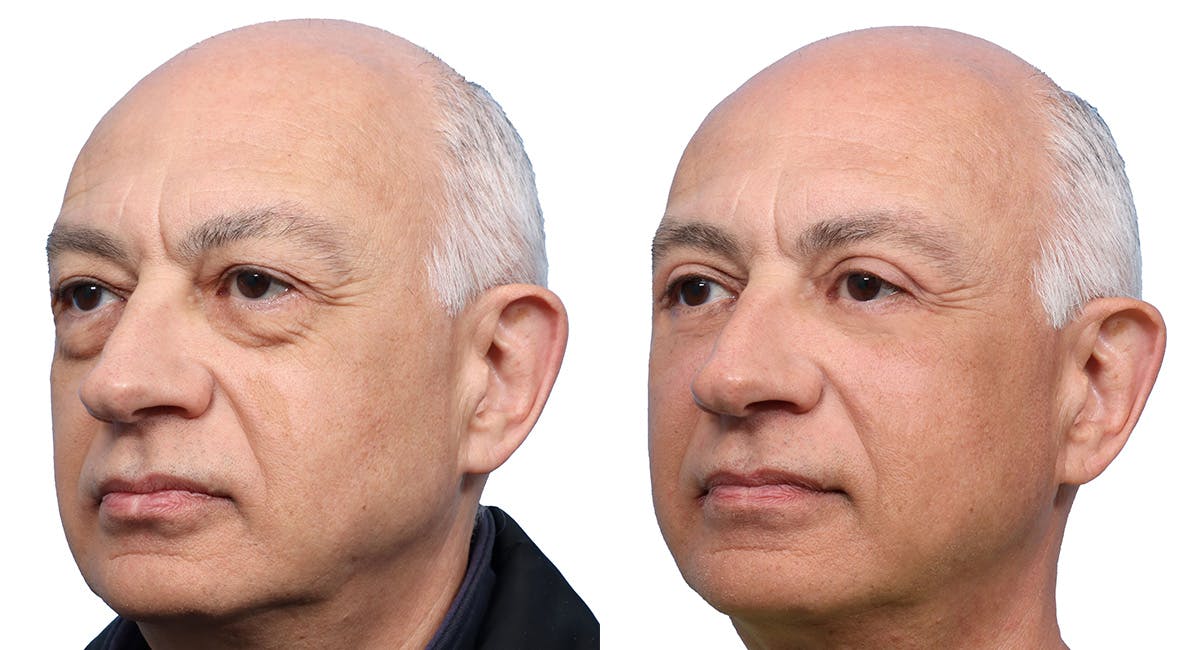 Blepharoplasty (Eyelid Surgery) Before & After Gallery - Patient 163451 - Image 2